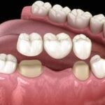 dental crown image