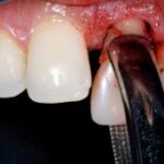 root canal image5