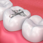 Best dental filling in Banashankari