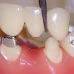 dental bridge 4 image