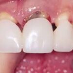 dental bridges2 image