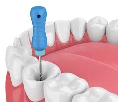 root canal treatment in bangalore