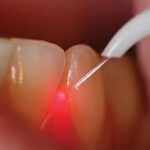 Best Lazer dentist in Banashankari