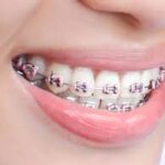 best quality braces and aligners