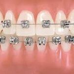 best quality braces and aligners