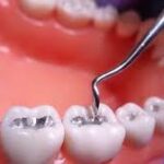 Best dental filling in Banashankari