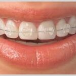 best quality braces and aligners