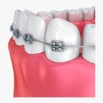 best quality braces and aligners