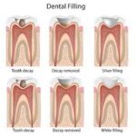 dental filling image3